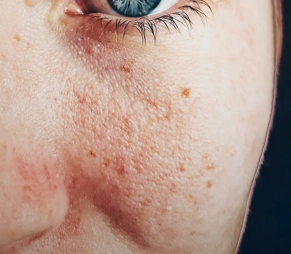 acne