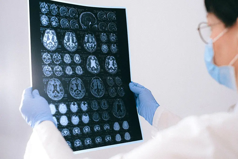 Meningitis: The doctor holds an x-ray of the brain in his hands