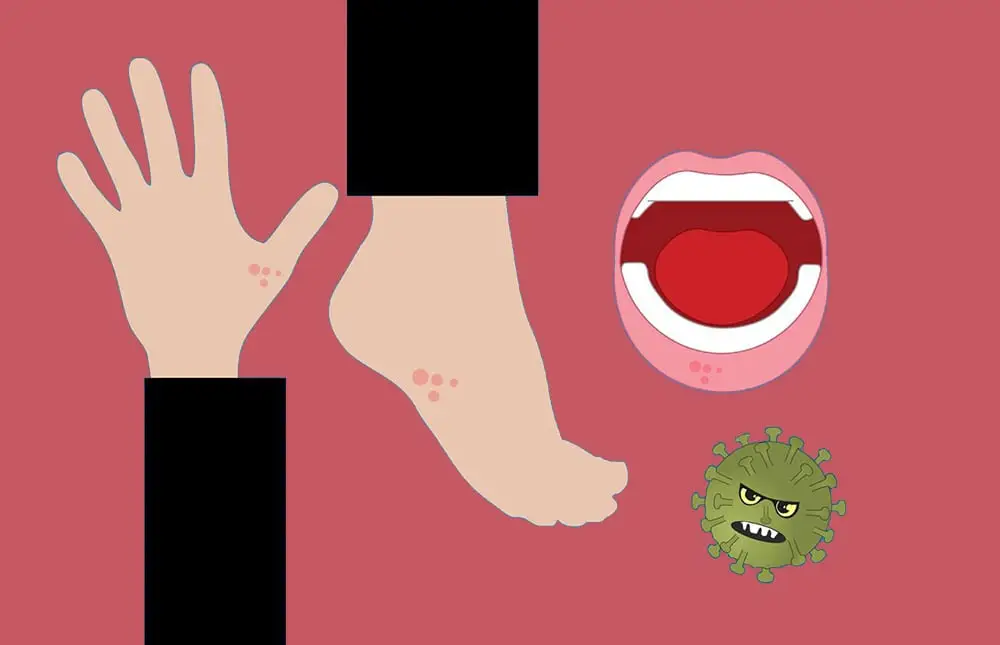 Scabies: graphic drawing of a leg, arm, mouth