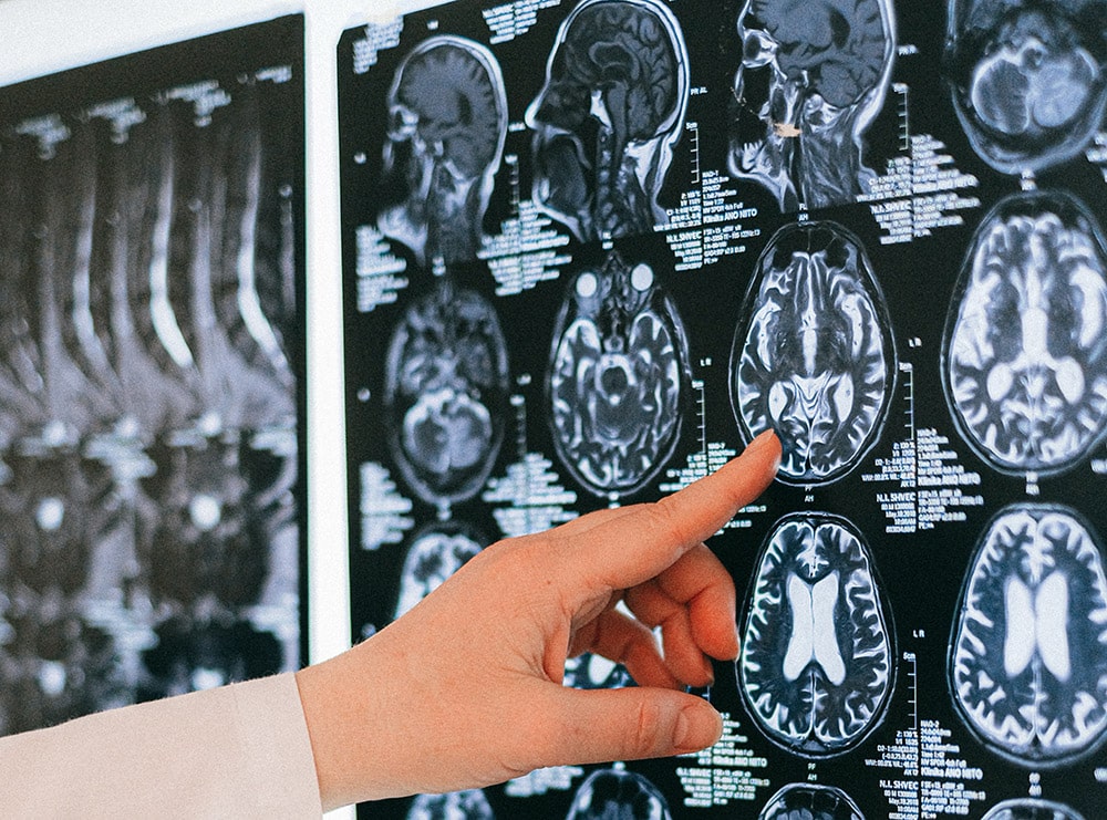 Udar mózgu: Lekarz wskazuje palcem na USD mózgu