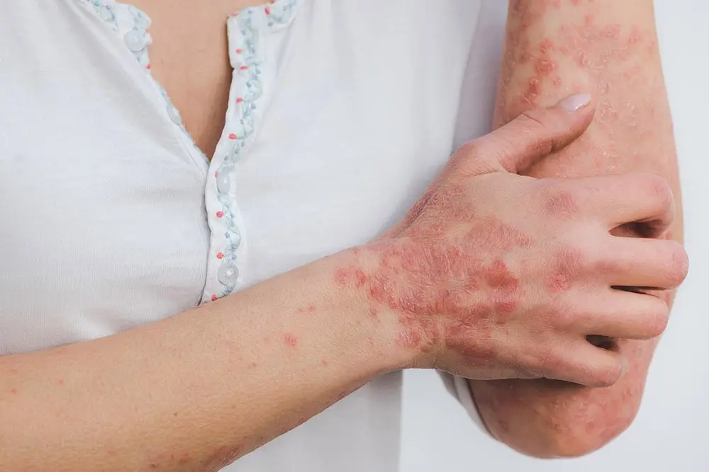 hives