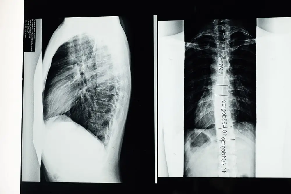 X-ray scoliosis