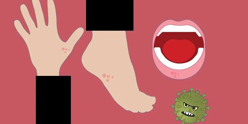 Scabies: graphic drawing of a leg, arm, mouth