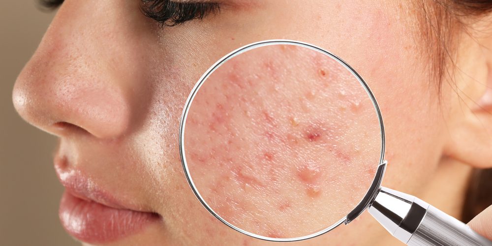 Teenage,Girl,With,Acne,Problem,Visiting,Dermatologist,,Closeup.,Skin,Under