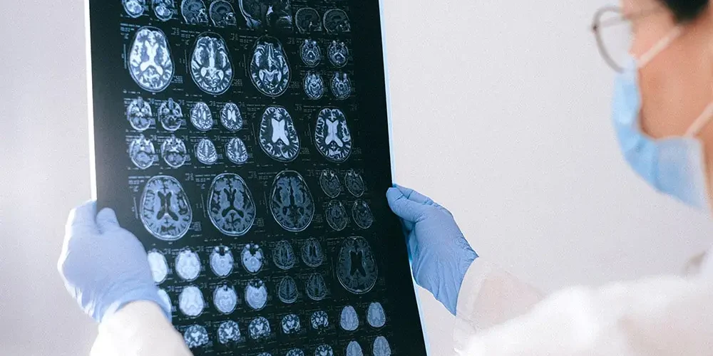 Meningitis: The doctor holds an x-ray of the brain in his hands