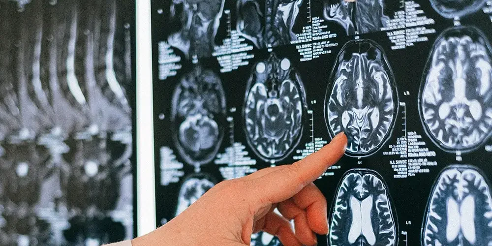 Stroke: The doctor points his finger at the USD of the brain