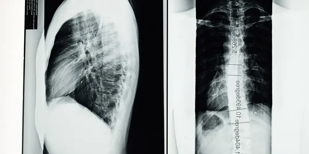 X-ray scoliosis